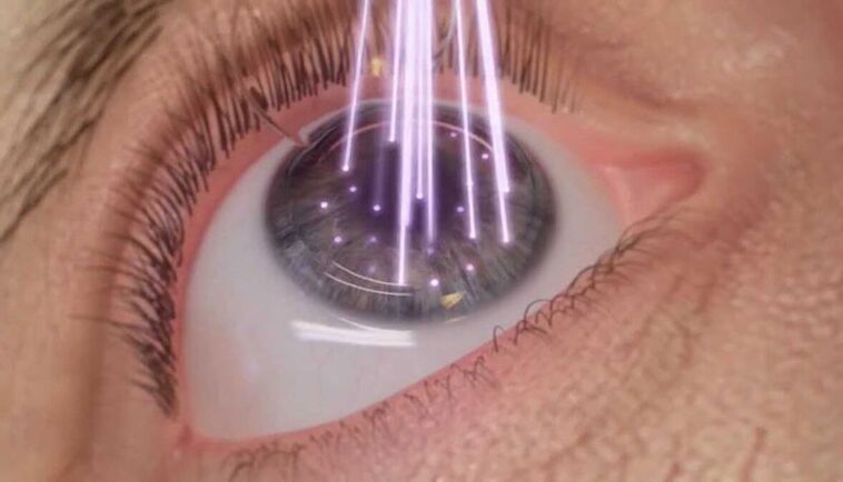 laser eye surgery