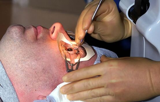 Scleroplasty for myopia to stabilize vision